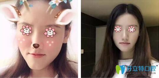 張揚主任口腔正畸案例