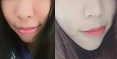 深圳牙齒矯正哪家好？看河山齒科齙牙妹正畸案例及對比圖